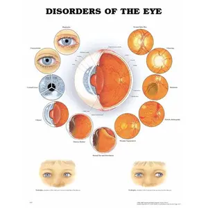 Disorders Of The Eye Diagram - 20" x 26"